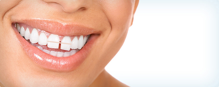 Teeth Gap Bands Close Gapped Teeth
