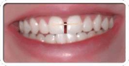 bands in teeth